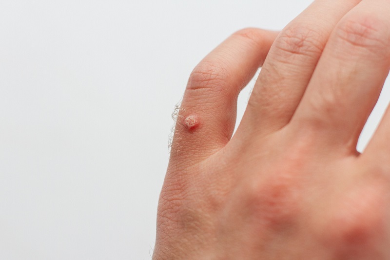 wart removal cape town 